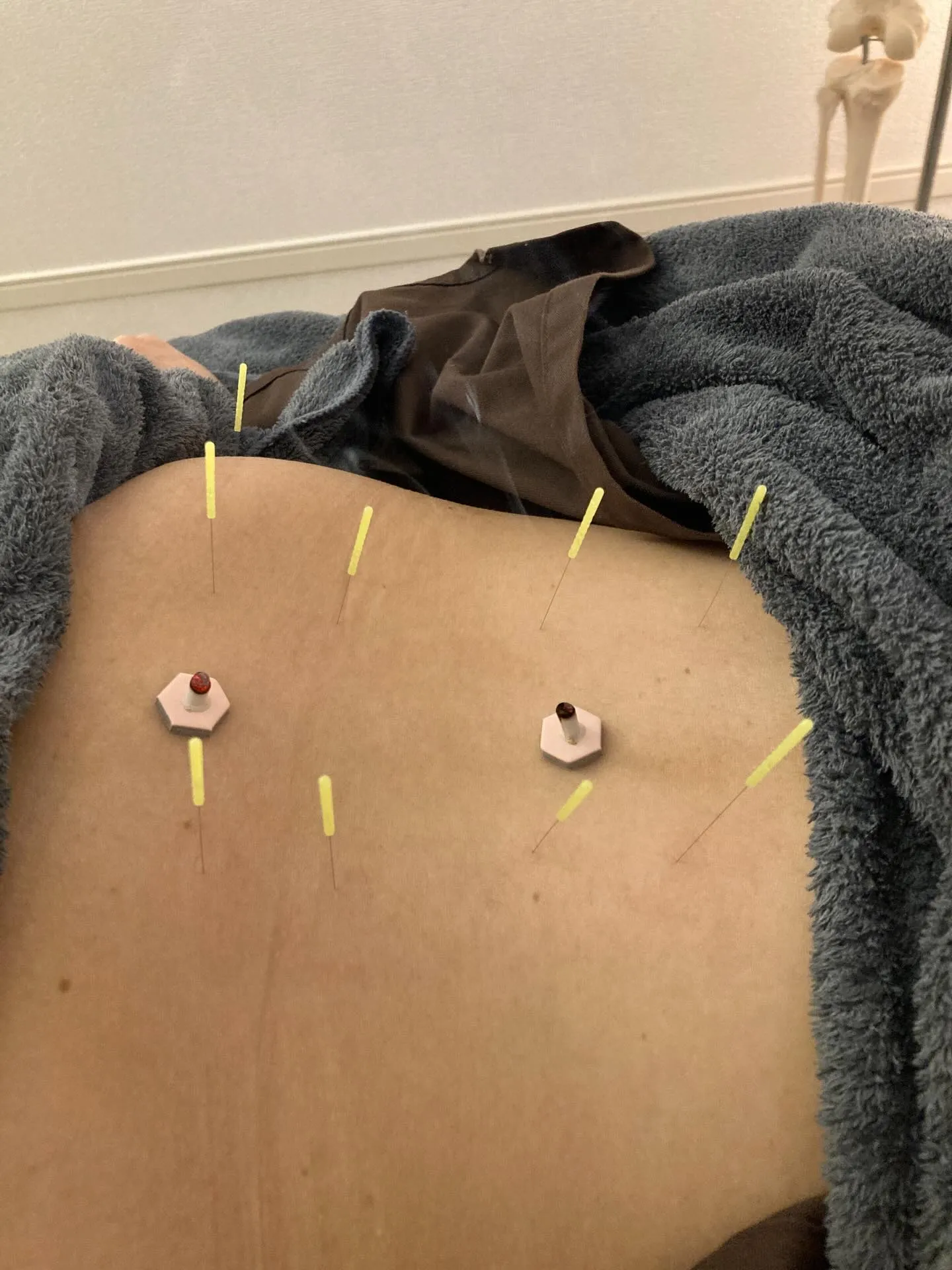 寒い季節こそ、鍼とお灸で身体を温めませんか？ 🔥❄️